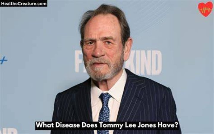 What Disease Does Tommy Lee Jones Have?